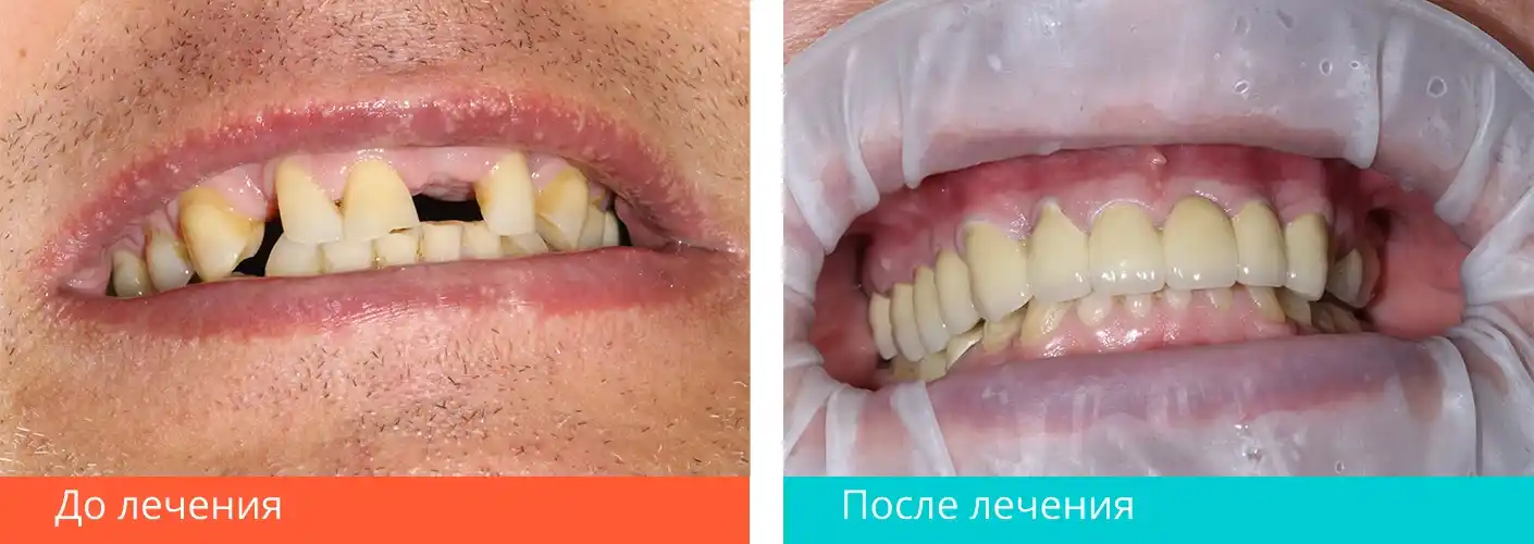 Протезирование зубов. Работа докторов «Гарант»