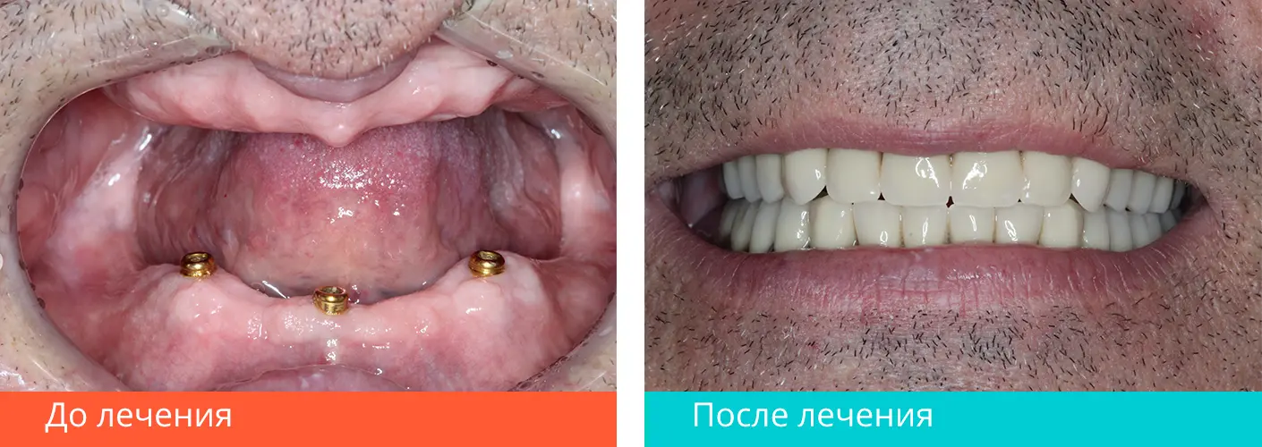 Протезирование зубов