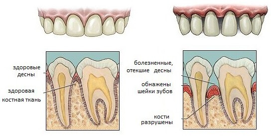 симптомы пародонтита